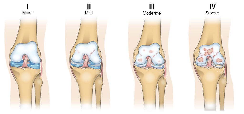 Illustration of four types of knees with the osteoarthritis stages: minor, mild, moderate and severe