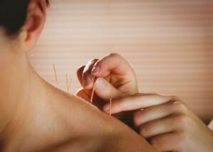 An acupuncturist putting an acupuncture needle in the upper trapezius, which is the upper back region, of a woman.